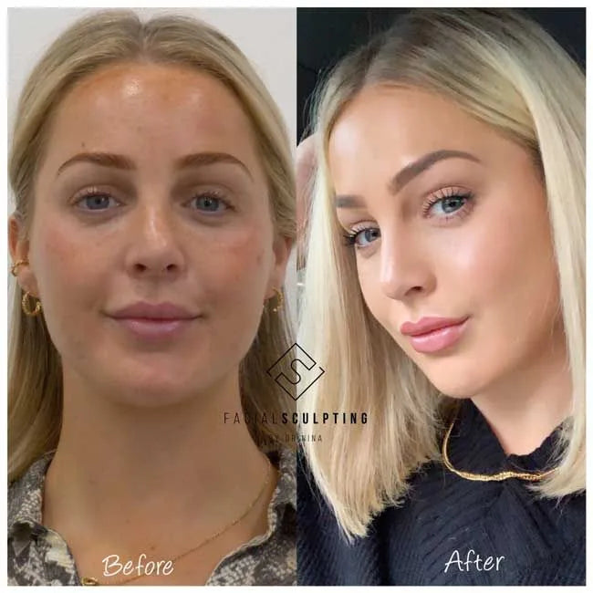 JawTone™ Advanced Jaw Exerciser (SALE LIVE 🔥🔥)